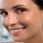Two Creams Match Hydroquinone for Melasma With Less Irritation